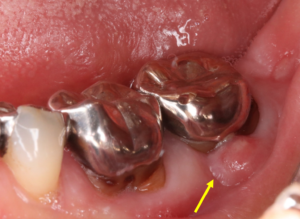ヘミセクション （奥歯の歯根の一部がダメになってしまったら 