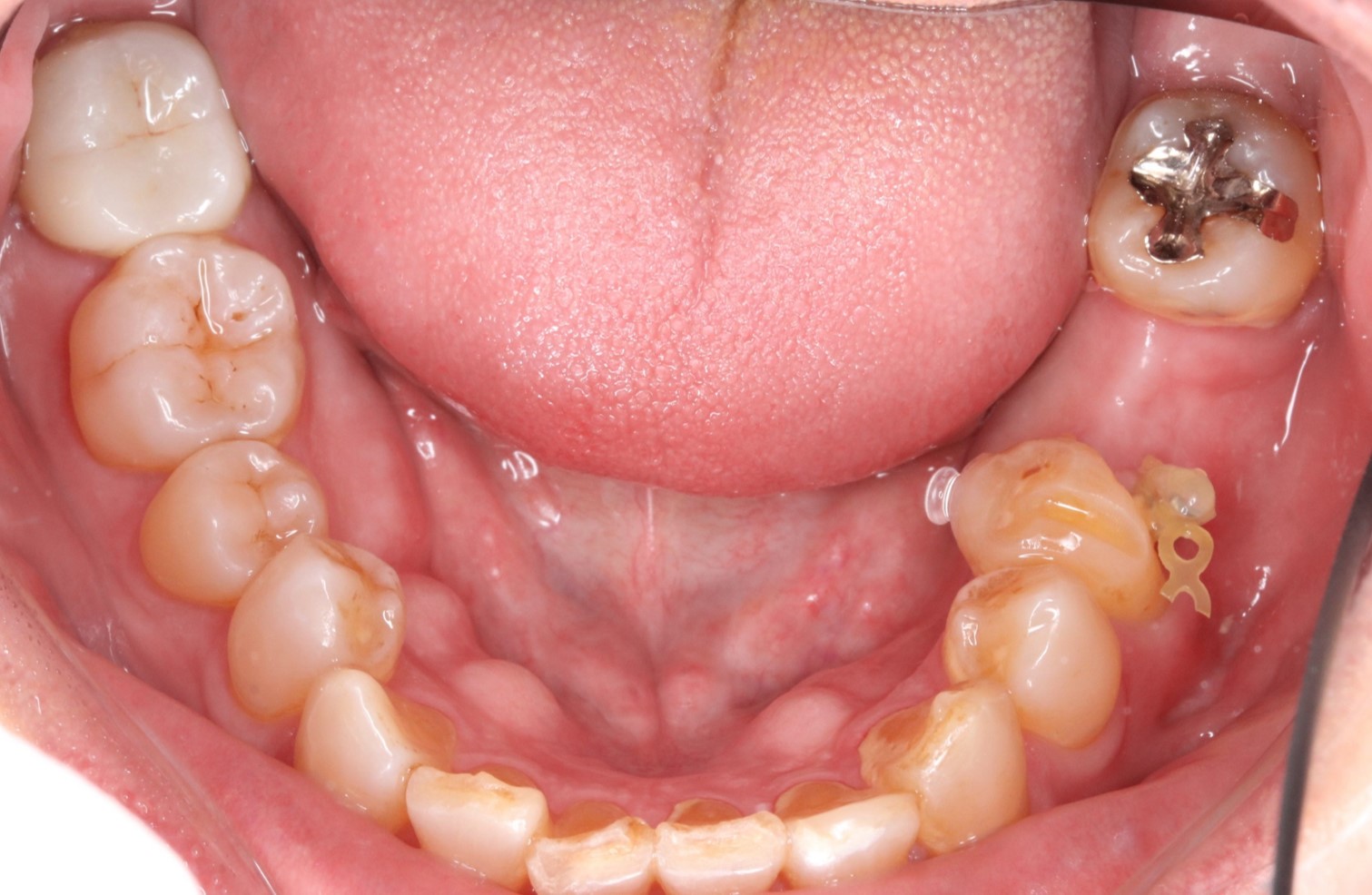 歯 が 内側 に 傾い て いる 原因